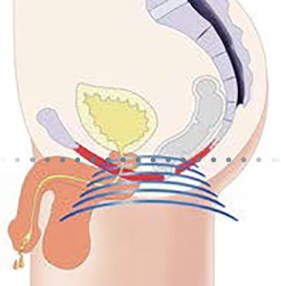 Behandlung der Beckenbodenmuskulatur mit dem UROPelviTone bei Männern